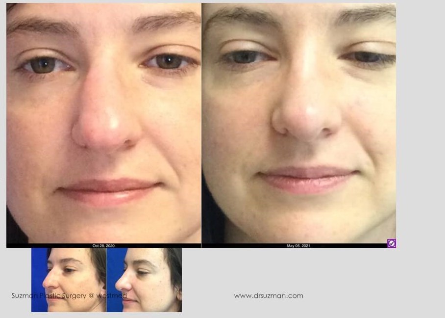 Dr. Suzman Rhinoplasty